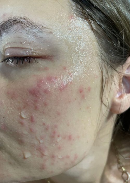 maszkviselés-bőrproblémák